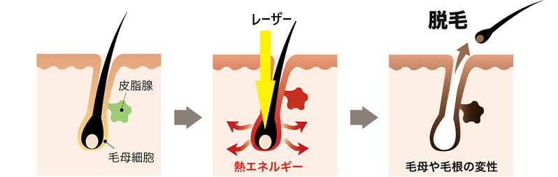 CNVレーザー脱毛 解説】医療脱毛の3種類のレーザーの特徴や違いとは